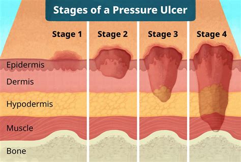 10 Stage 4 Decubitus Ulcer Pictures For Awareness