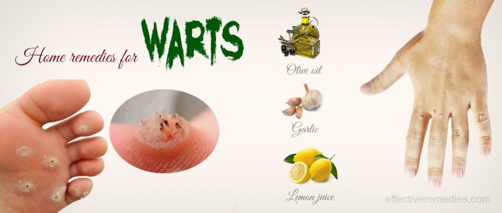 34 Proven Natural Home Remedies For Warts On Hands Feet