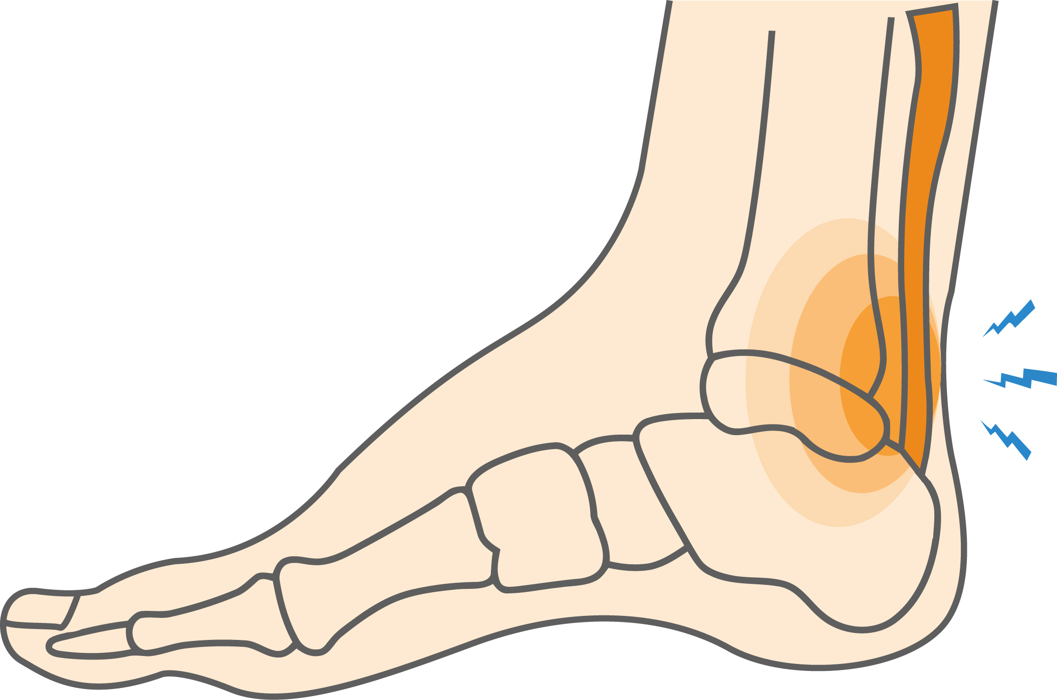 Achilles Tendonitis