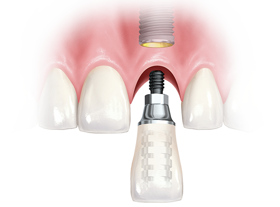 Advantages And Practicality Of Immediate Loading Dental Implants