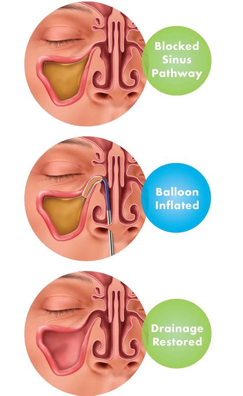 Balloon Sinuplasty In Office Sinus Surgery Ent Doctor Charlotte Nc Monroe Nc Indian