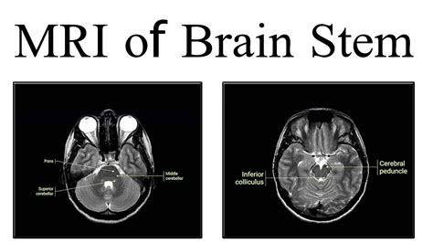 Brainstem On Mri