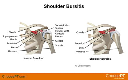 Bursitis Treatment Guide: Heal Without Surgery