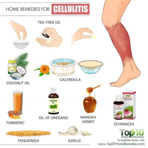 Cellulitis What Are It S Natural Remedies Alternative Medicine