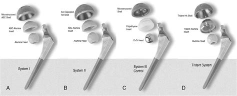 Ceramic On Ceramic Total Hip Arthroplasty Update The Journal Of