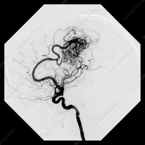 Cerebral Angiogram Of Avm Stock Image C027 1577 Science Photo Library