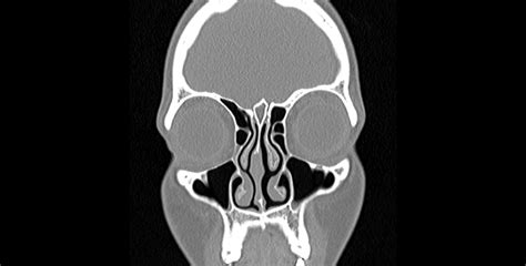 Ct Scan Of Sinus: Accurate Diagnosis Guaranteed