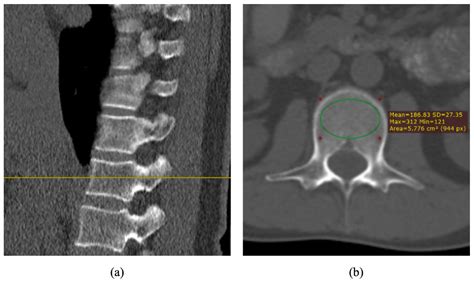 Diagnosis Of Osteoporosis By Quantifying Volumetric Bone Mineral Density Of Lumbar Vertebrae