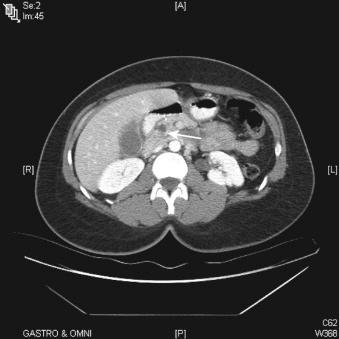 Dilated Bile Duct And Pneumobilia Clinical Tree