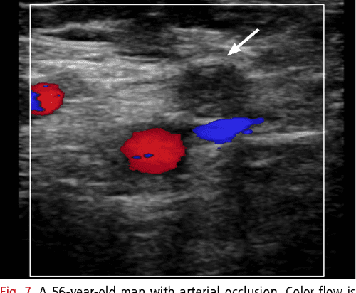 Doppler Ultrasonography Of The Lower Extremity Arteries Anatomy And Scanning Guidelines