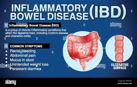 Feinstein Ibd Clinical Center: Expert Care For Inflammatory Bowel Disease