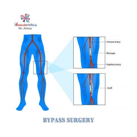 Femoral Popliteal Artery Bypass