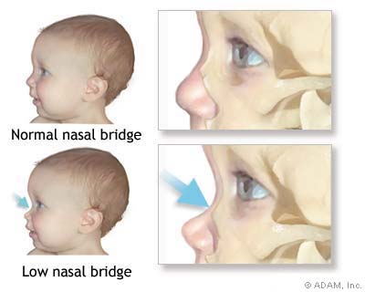 Flat Nasal Bridge