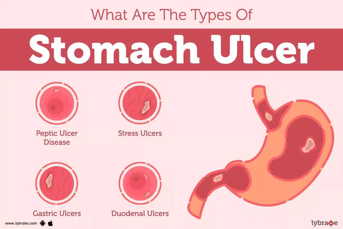 Gastric Ulcer Guide: Symptoms And Treatment