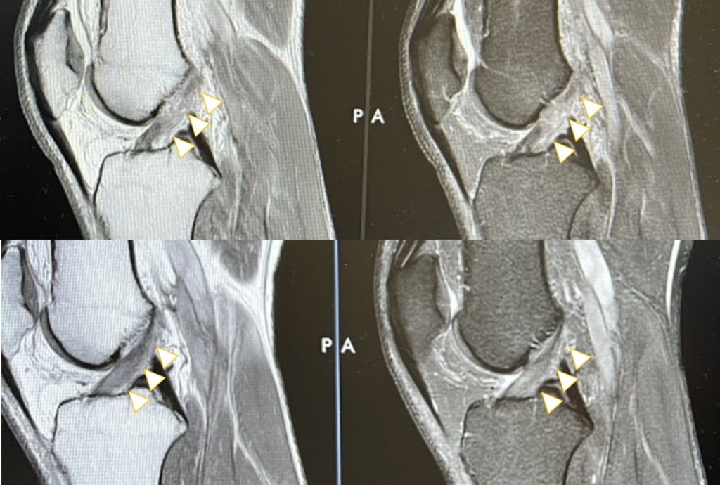 Healing Another Acl Without Surgery Regenexx