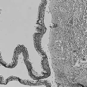 Histopathological Features Blisters Along With Suprabasilar Download Scientific Diagram