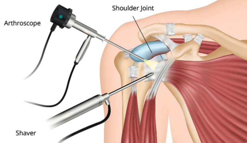 How Does Shoulder Arthroscopy Work? Recovery Tips Inside