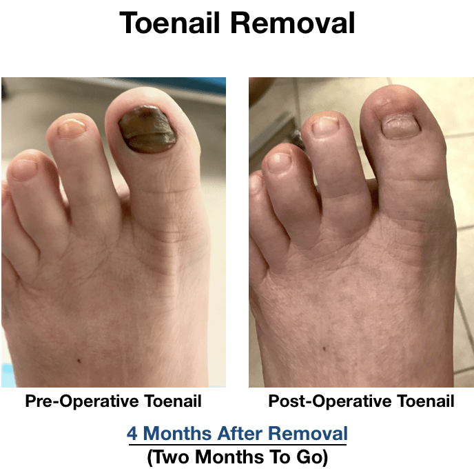 How To Care For Toenail Removal? Fast Recovery Guide