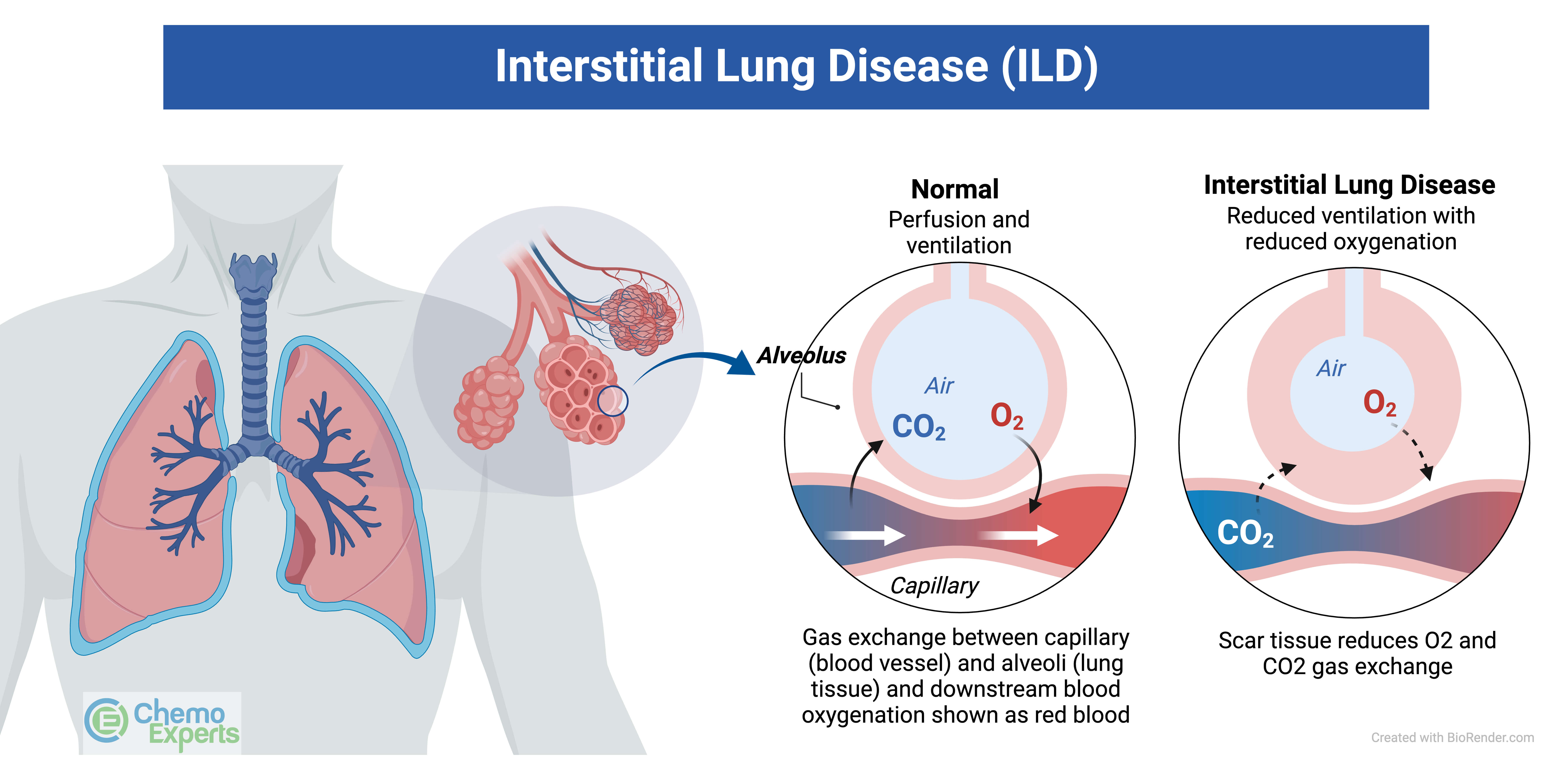 How To Diagnose Interstitial Lung Disease Early? Get Answers