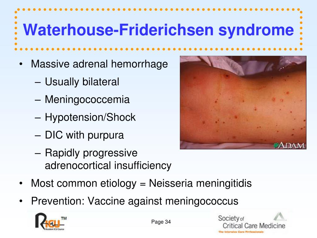 How To Manage Friedrichsen Waterhouse Symptoms? Treatment Options