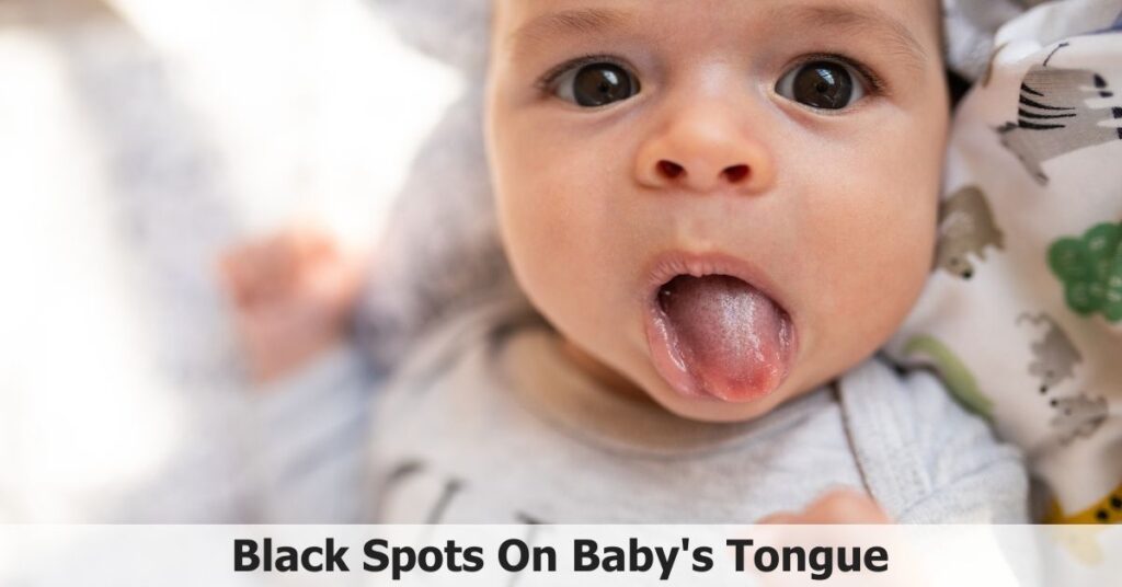 How To Treat Black Spots On Newborn Tongue?