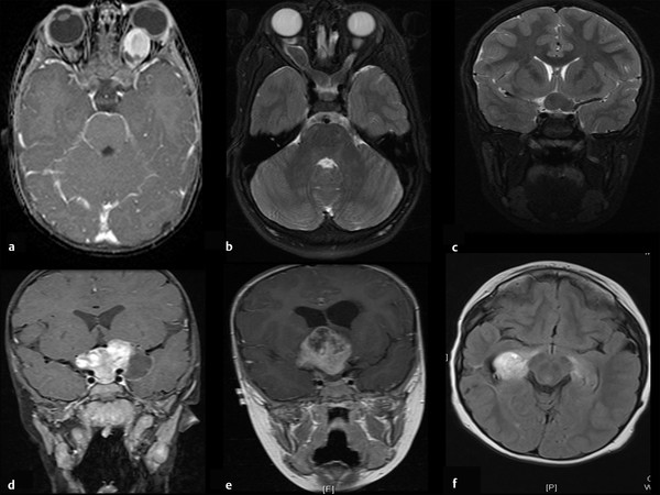 Hypothalamic Neoplasms Hypothalamic Tumors Hypothalamic Chiasmatic Neoplasms Hypothalamic