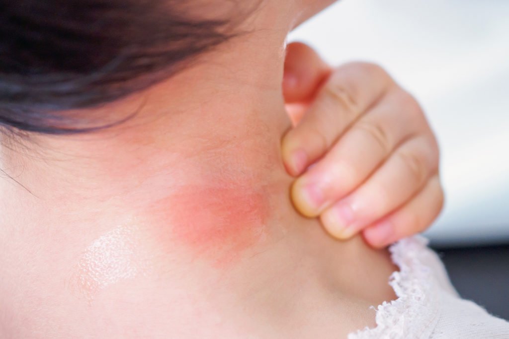 Insect Bites And Stings Health And Medical Information