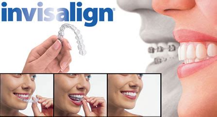 Invisalign Treatment In Mt Sinai Mt Sinai Family Dental