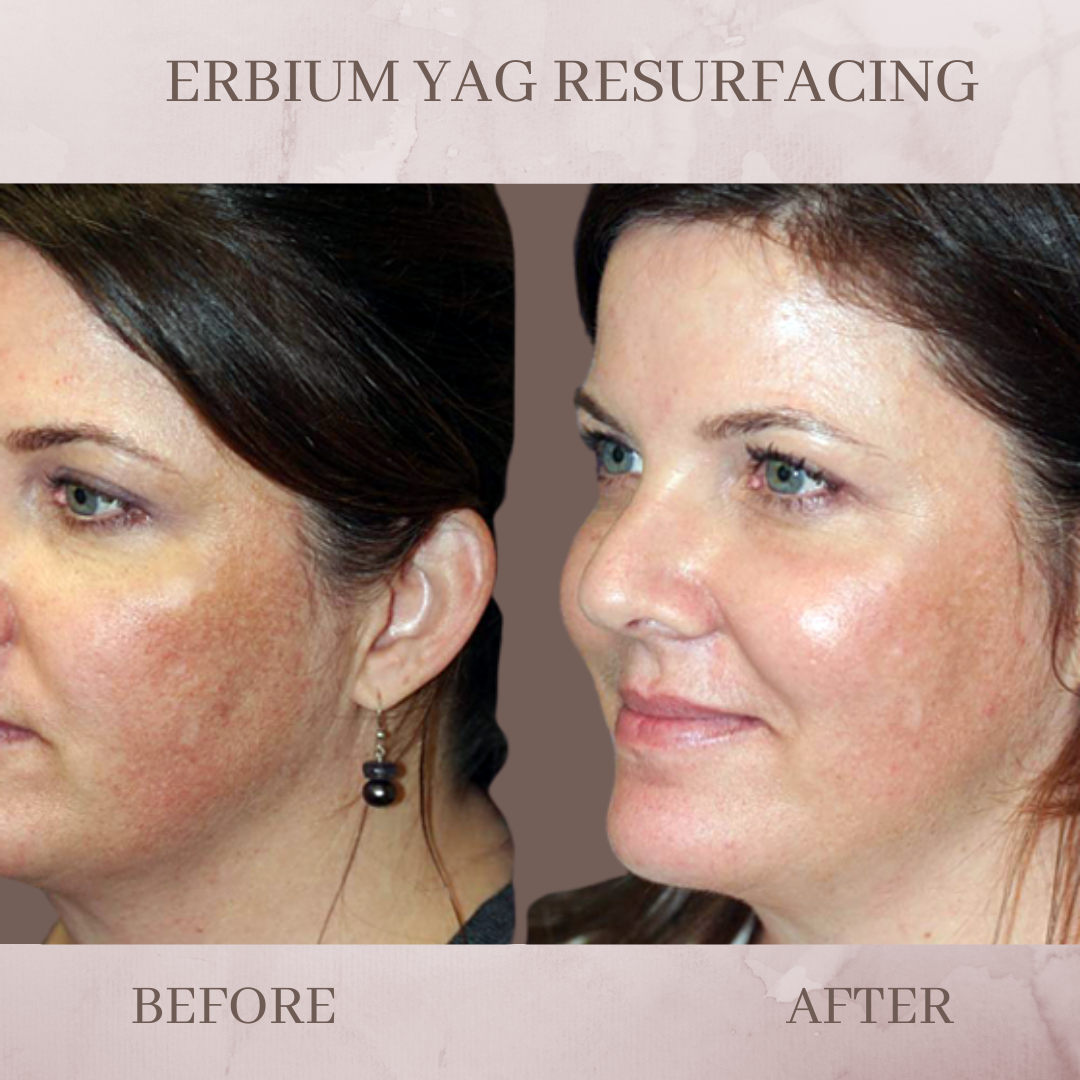 Laser Skin Resurfacing Nyc