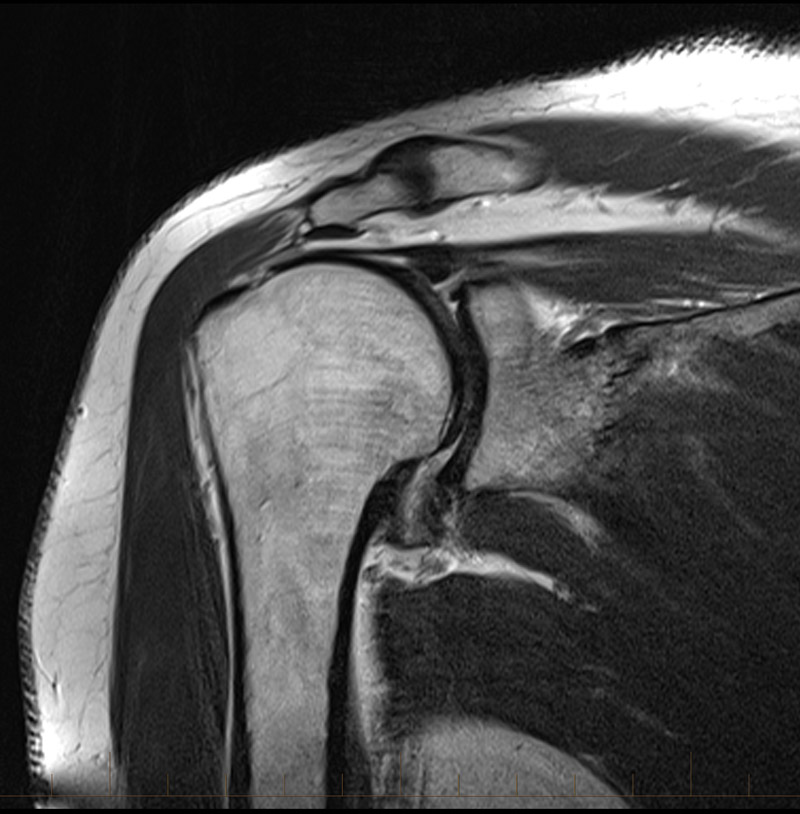 Mri Of A Shoulder