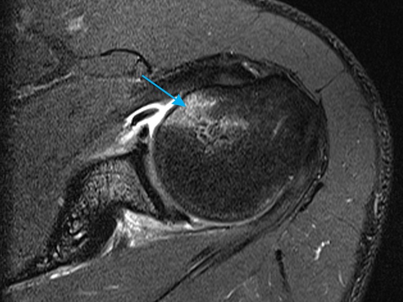 Mri Shoulder Musculoskeletal Imaging