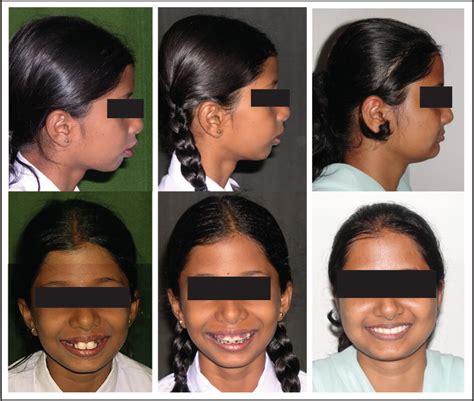 Multistage Treatment Of A Class Ii Division 1 Malocclusion With Severe Crowding B Sangamesh 2020