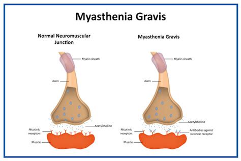 Myasthenia Gravis Causes Symptoms Treatment Options