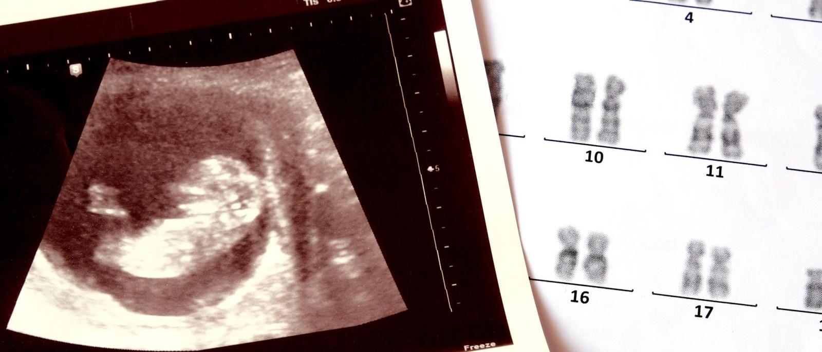 New Prenatal Test Can Reduce Time Cost Of Detecting Chromosomal Abnormalities