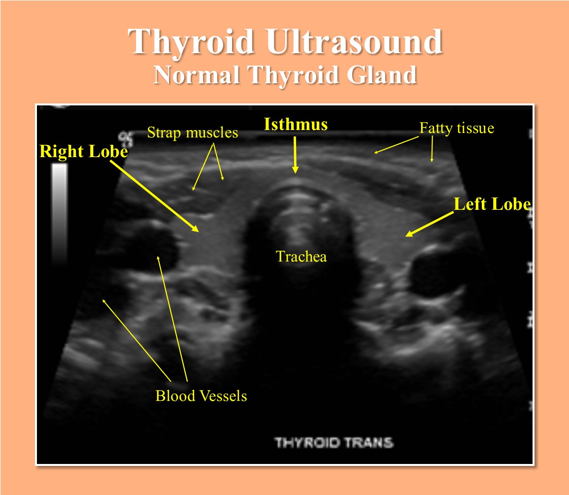 Normal Thyroid Gland Ultrasound