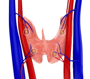 Parathyroid Surgery The Woodlands Parathyroidectomy The Woodlands