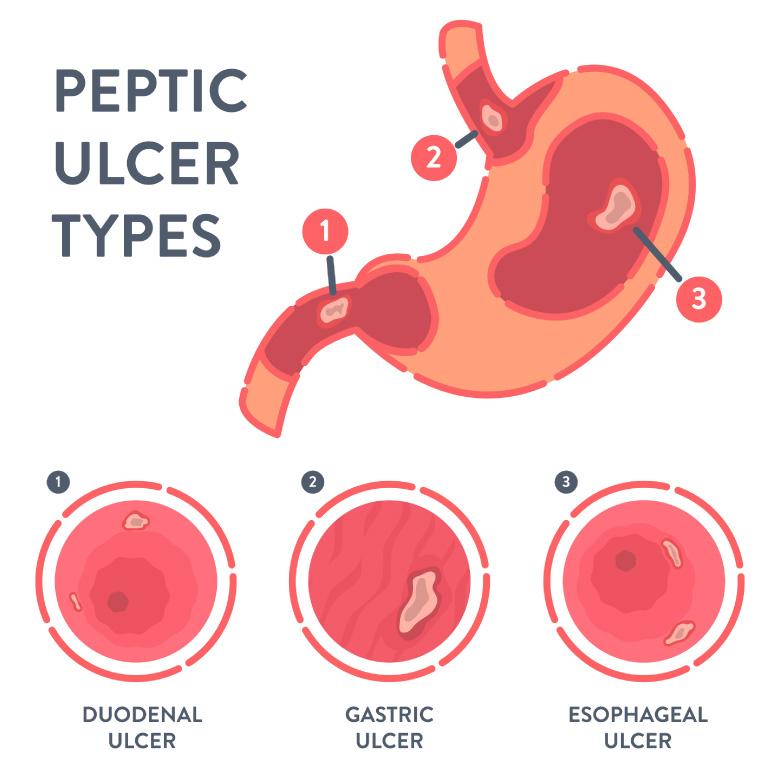 Peptic Ulcers Symptoms Causes Parkway East Hospital