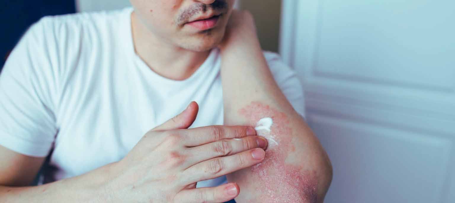 Psoriasis Specialist Nyc