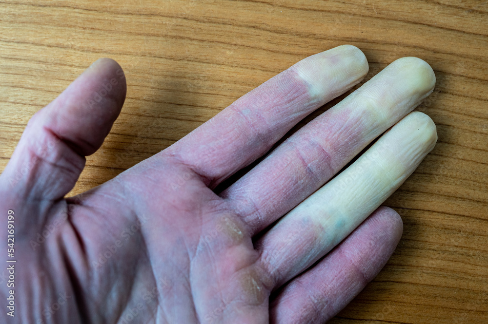 Raynaud S Syndrome Children Children S National