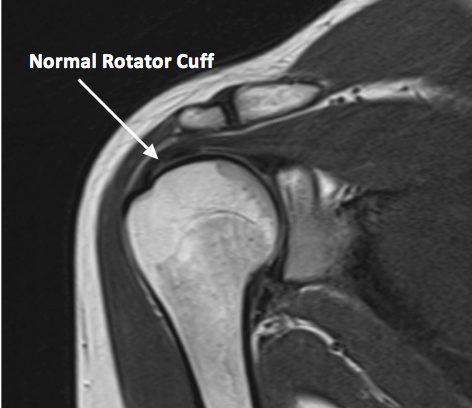 Shoulder Joint Anatomy Mri