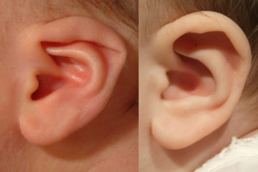 Skin Tag On Newborn Ear: Safe Treatment Options