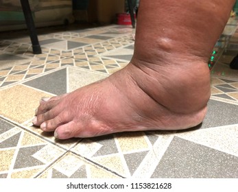 Swollen Ankle In Elderly