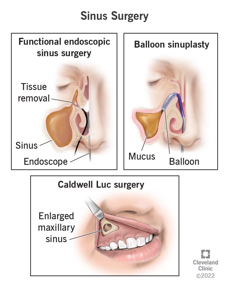 The Best Remedy To Clean Your Sinuses Beautyhealther Org