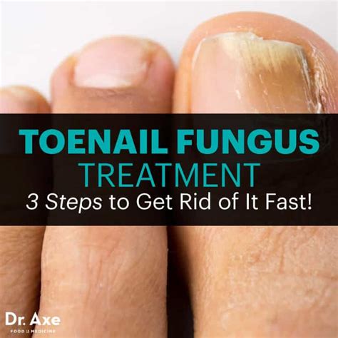 Toenail Fungus Treatment 3 Steps To Get Rid Of It Fast Dr Axe