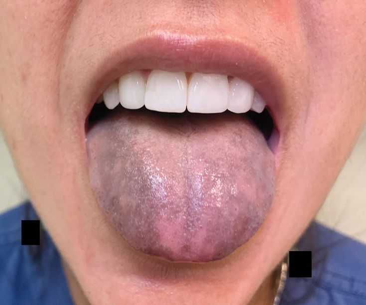 Tongue Discoloration In A Young Girl The Journal Of Pediatrics