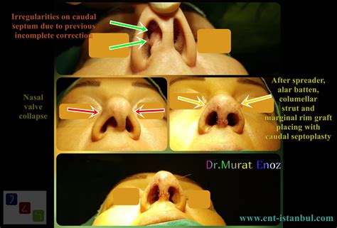 We Performed Revision Open Technique Caudal Septoplasty Nasal Valve Surgery