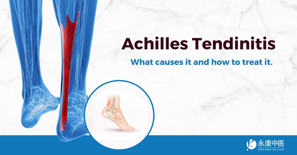 What Causes Achilles Tendinitis? Relief Solutions