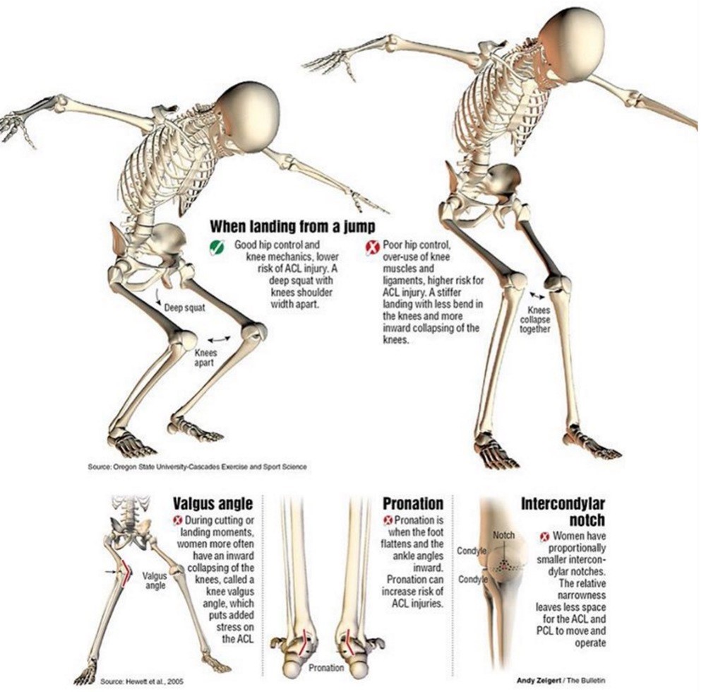 What Happens When Running With Acl Tear? Injury Prevention Tips